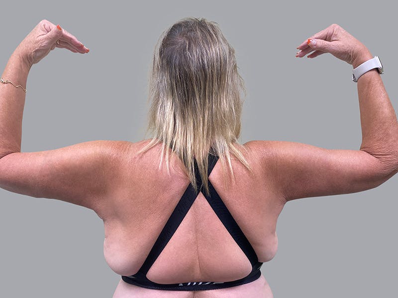 Arm Lift Before & After Gallery - Patient 63984481 - Image 2