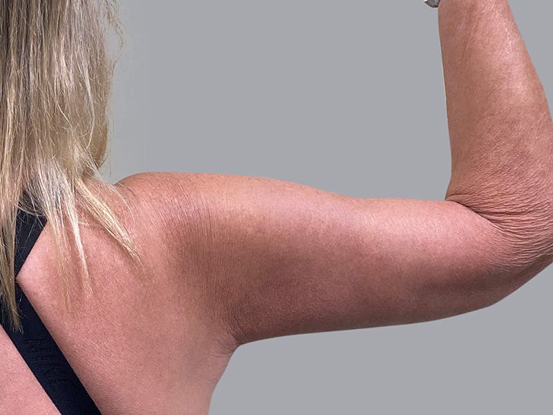 Arm Lift Before & After Gallery - Patient 63984481 - Image 4