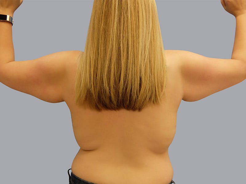 Arm Lift Before & After Gallery - Patient 48697826 - Image 1
