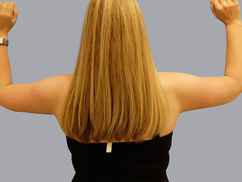 Arm Lift Before & After Gallery - Patient 48697826 - Image 2