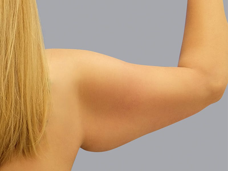 Arm Lift Before & After Gallery - Patient 48697826 - Image 3