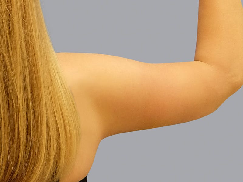 Arm Lift Before & After Gallery - Patient 48697826 - Image 4