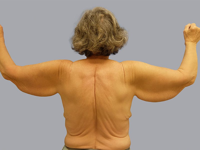 Arm Lift Before & After Gallery - Patient 55333286 - Image 1