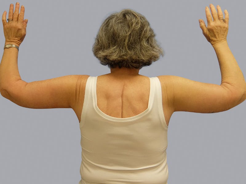 Arm Lift Before & After Gallery - Patient 55333286 - Image 2