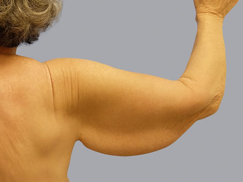 Arm Lift Before & After Gallery - Patient 55333286 - Image 3