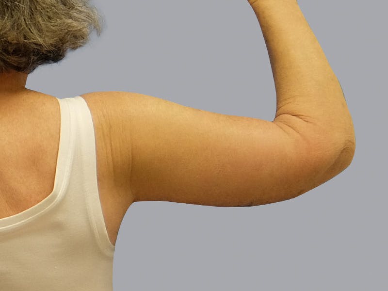 Arm Lift Before & After Gallery - Patient 55333286 - Image 4