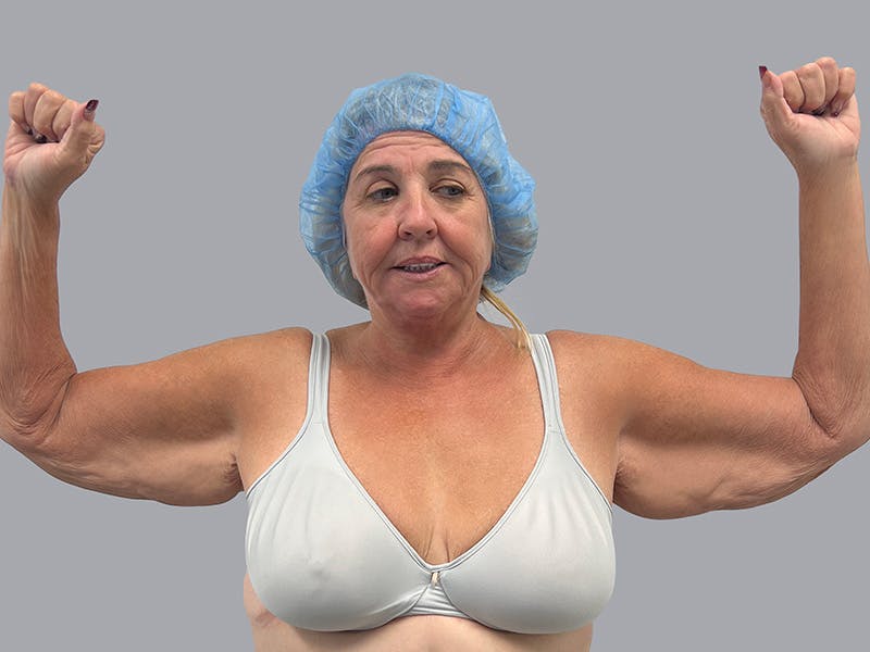 Arm Lift Before & After Gallery - Patient 63984481 - Image 1