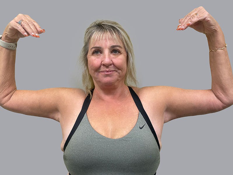 Arm Lift Before & After Gallery - Patient 63984481 - Image 2