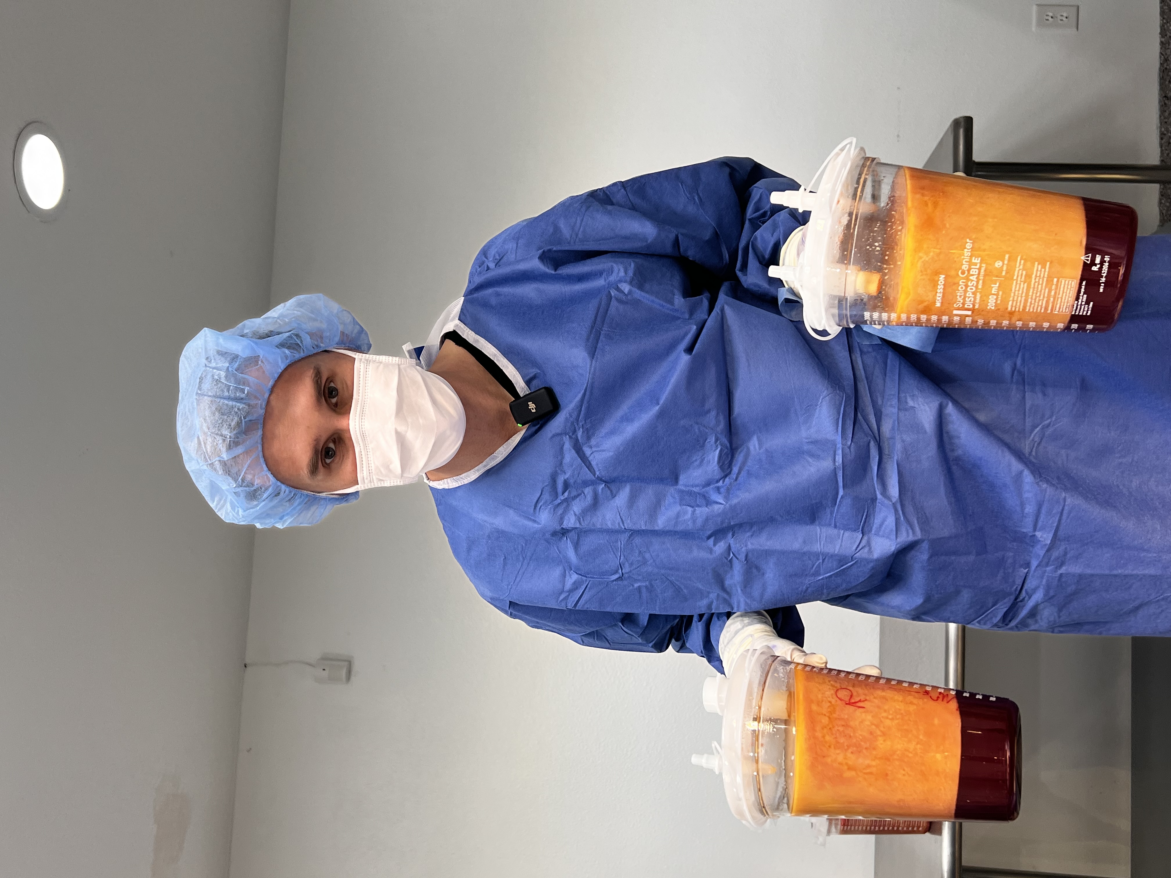 Dr. Markelov with pitchers of liposuctioned fat
