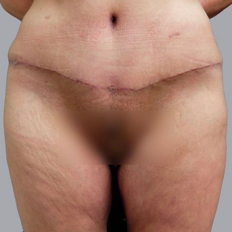 Thigh Lift Before & After Gallery - Patient 106361048 - Image 2