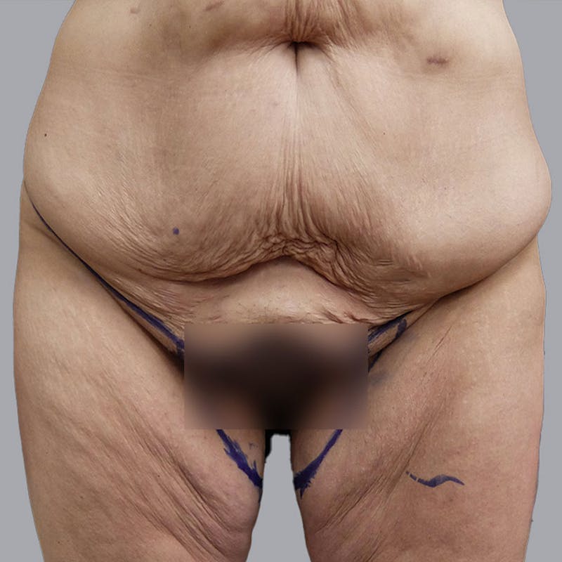 Thigh Lift Before & After Gallery - Patient 106361048 - Image 1