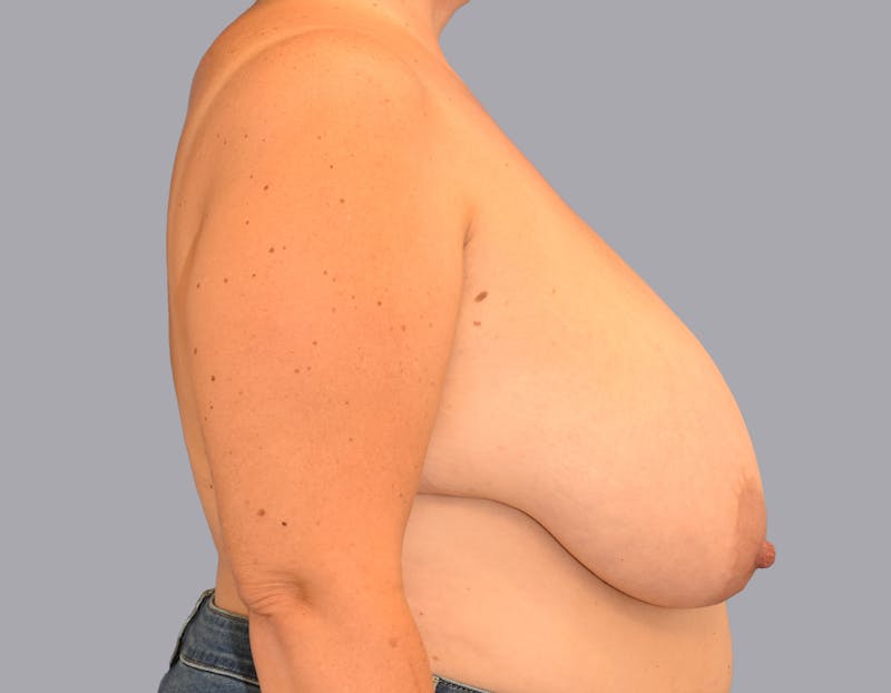 Breast Reduction Before & After Gallery - Patient 55333069 - Image 5