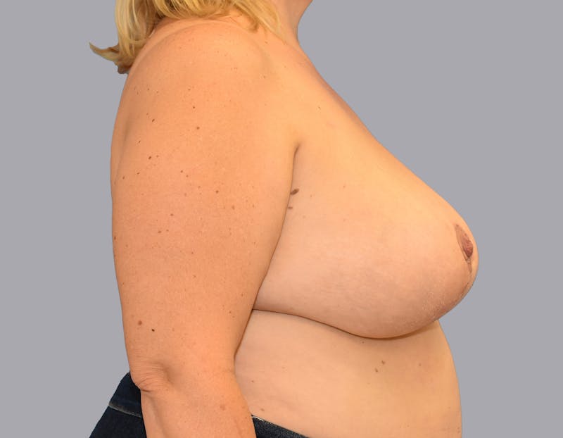 Breast Reduction Before & After Gallery - Patient 55333069 - Image 6