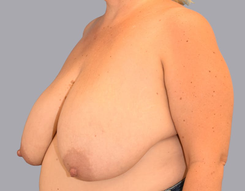 Breast Reduction Before & After Gallery - Patient 55333069 - Image 7