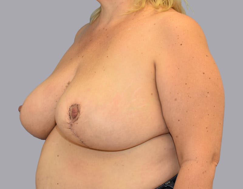 Breast Reduction Before & After Gallery - Patient 55333069 - Image 8