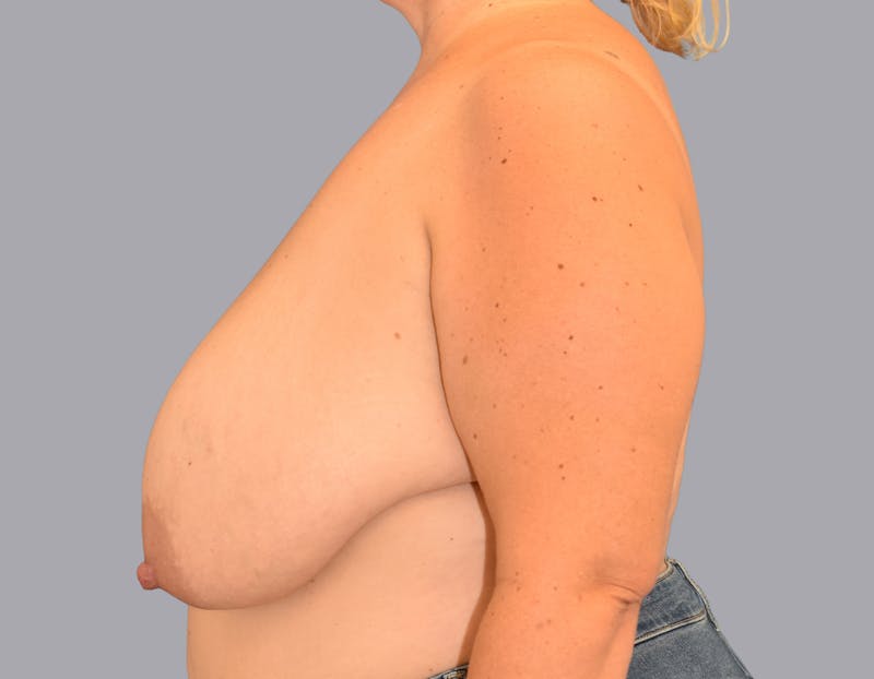 Breast Reduction Before & After Gallery - Patient 55333069 - Image 9
