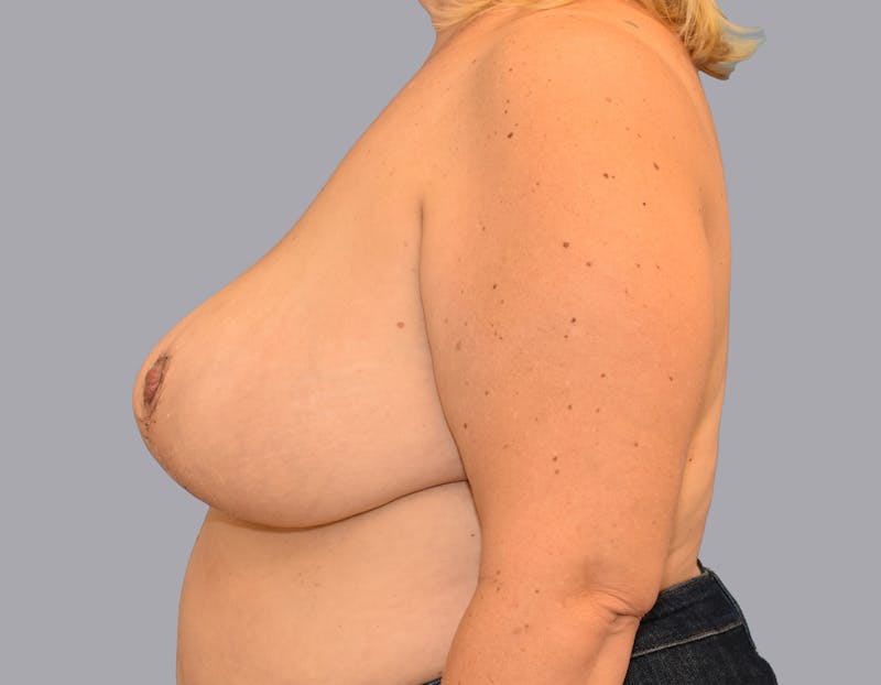 Breast Reduction Before & After Gallery - Patient 55333069 - Image 10