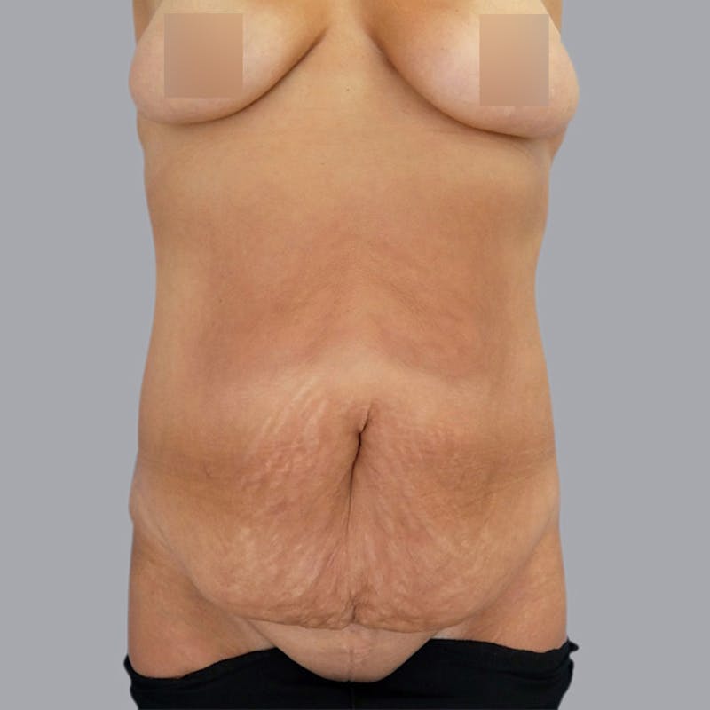 Abdominoplasty Before & After Gallery - Patient 48704249 - Image 1