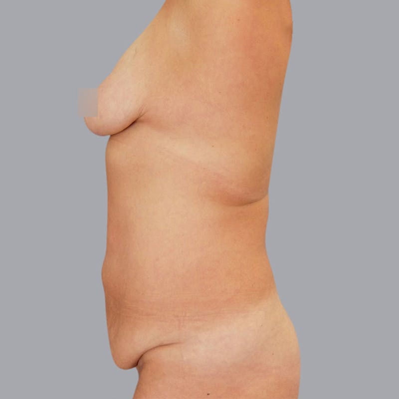 Abdominoplasty Before & After Gallery - Patient 48704249 - Image 5