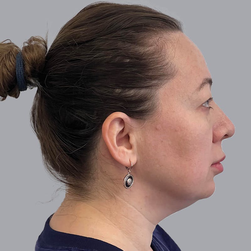 Chin Before & After Gallery - Patient 792380 - Image 1