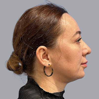 Blepharoplasty Before & After Gallery - Patient 423174 - Image 2