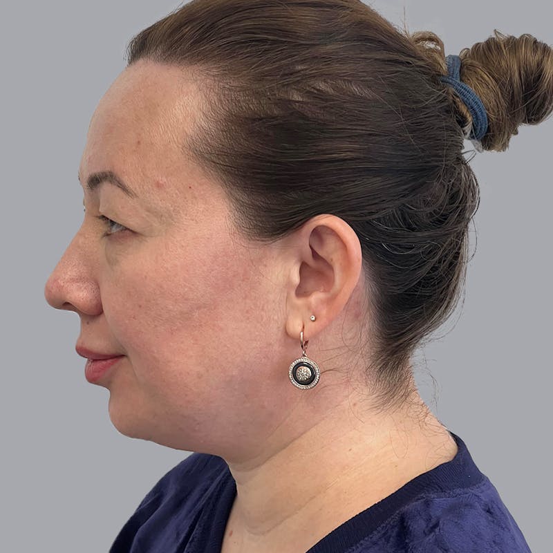 Chin Lipo Before & After Gallery - Patient 106440203 - Image 3
