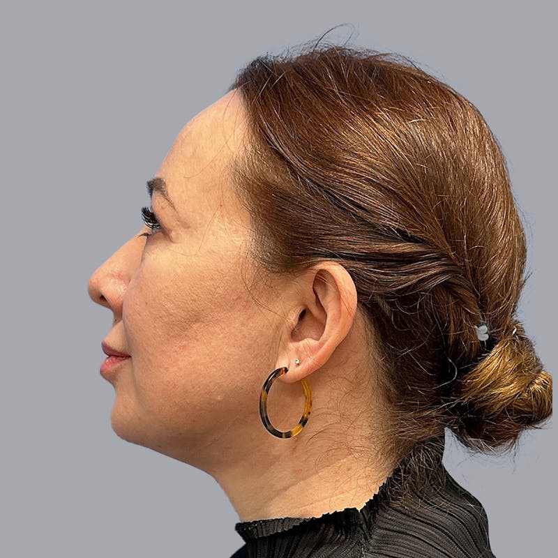 Chin Lipo Before & After Gallery - Patient 106440203 - Image 4