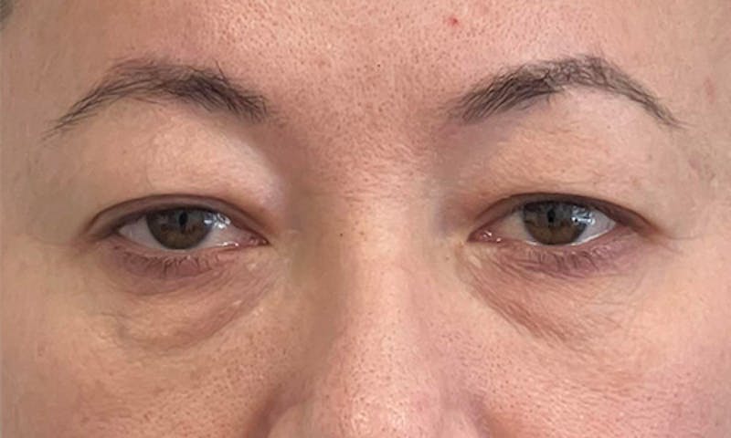 Blepharoplasty Before & After Gallery - Patient 106440197 - Image 1