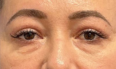 Blepharoplasty Before & After Gallery - Patient 106440197 - Image 4