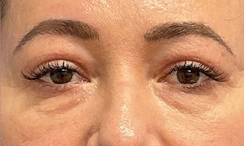 Blepharoplasty Before & After Gallery - Patient 106440197 - Image 2