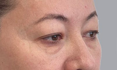 Blepharoplasty Before & After Gallery - Patient 106440197 - Image 5