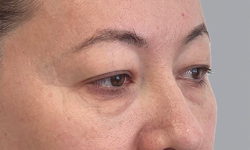 Blepharoplasty Before & After Gallery - Patient 106440197 - Image 3