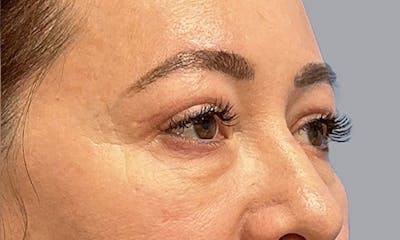 Blepharoplasty Before & After Gallery - Patient 106440197 - Image 6