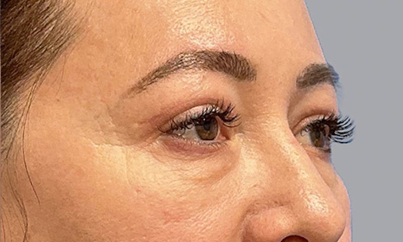 Blepharoplasty Before & After Gallery - Patient 106440197 - Image 4