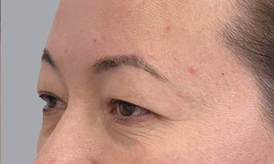Blepharoplasty Before & After Gallery - Patient 106440197 - Image 1