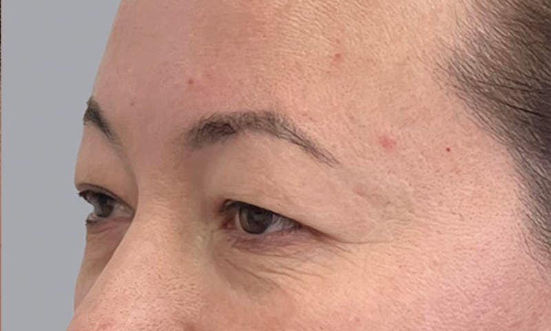 Blepharoplasty Before & After Gallery - Patient 106440197 - Image 5