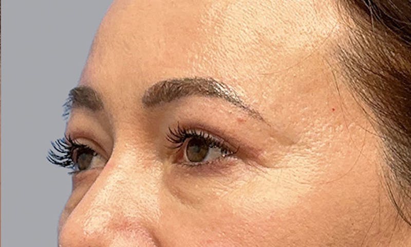 Blepharoplasty Before & After Gallery - Patient 106440197 - Image 6