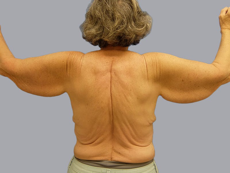 Arm Lift Before & After Gallery - Patient 106613127 - Image 1