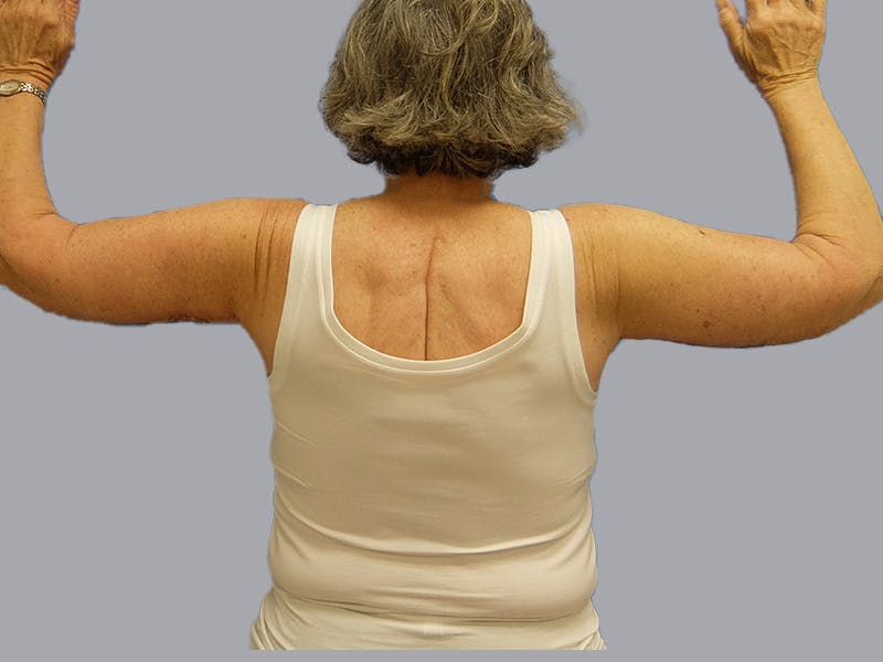 Arm Lift Before & After Gallery - Patient 106613127 - Image 2