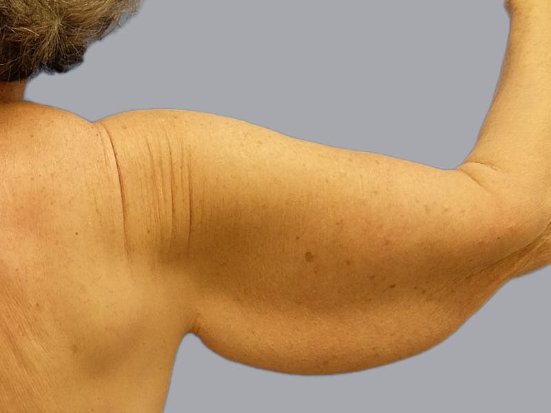 Arm Lift Before & After Gallery - Patient 106613127 - Image 3