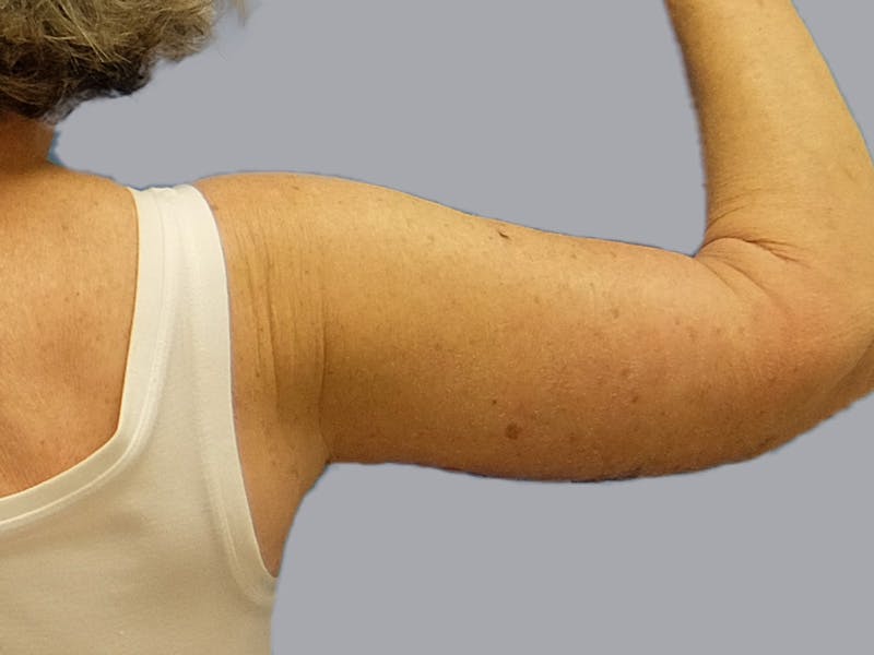 Arm Lift Before & After Gallery - Patient 106613127 - Image 4