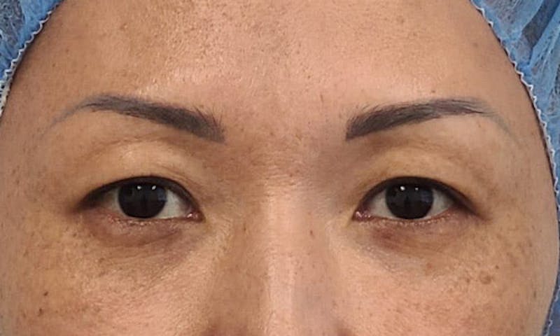 Blepharoplasty Before & After Gallery - Patient 106613164 - Image 1