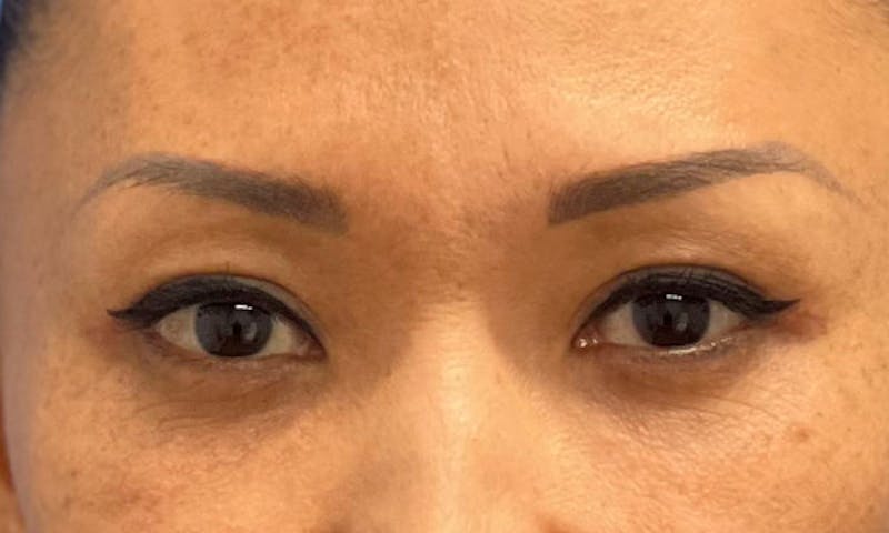 Blepharoplasty Before & After Gallery - Patient 106613164 - Image 2