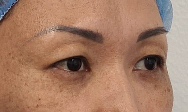 Blepharoplasty Before & After Gallery - Patient 106613164 - Image 3