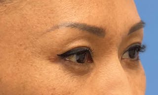 Blepharoplasty in Tampa Before & After Gallery - Patient 106613164 - Image 4