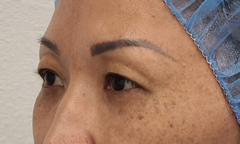 Blepharoplasty Before & After Gallery - Patient 106613164 - Image 5