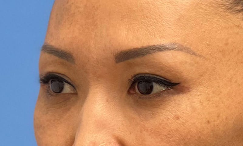 Blepharoplasty Before & After Gallery - Patient 106613164 - Image 6