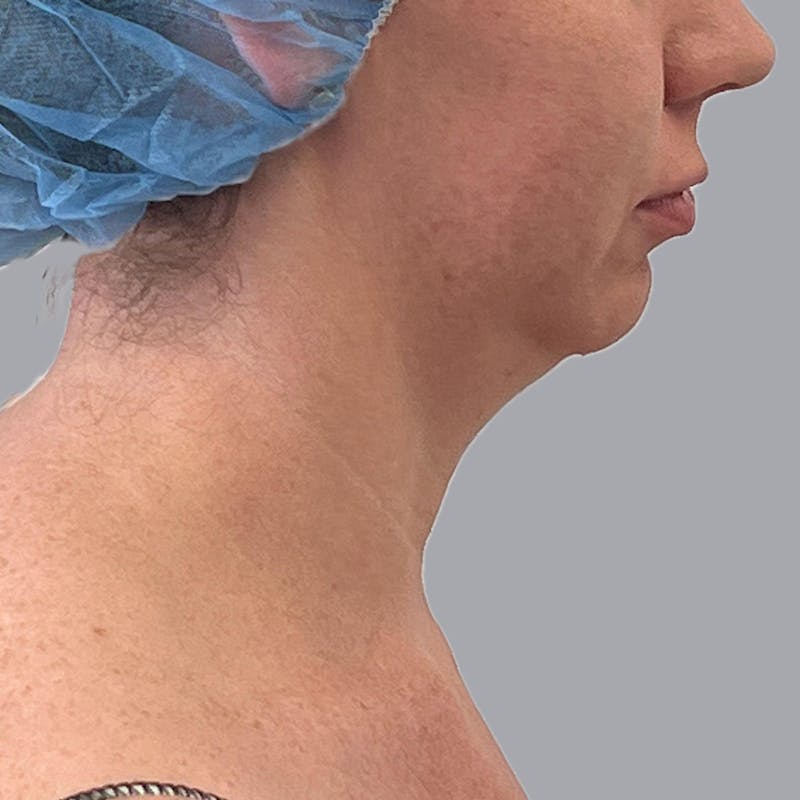 Liposuction Before & After Gallery - Patient 106613211 - Image 1