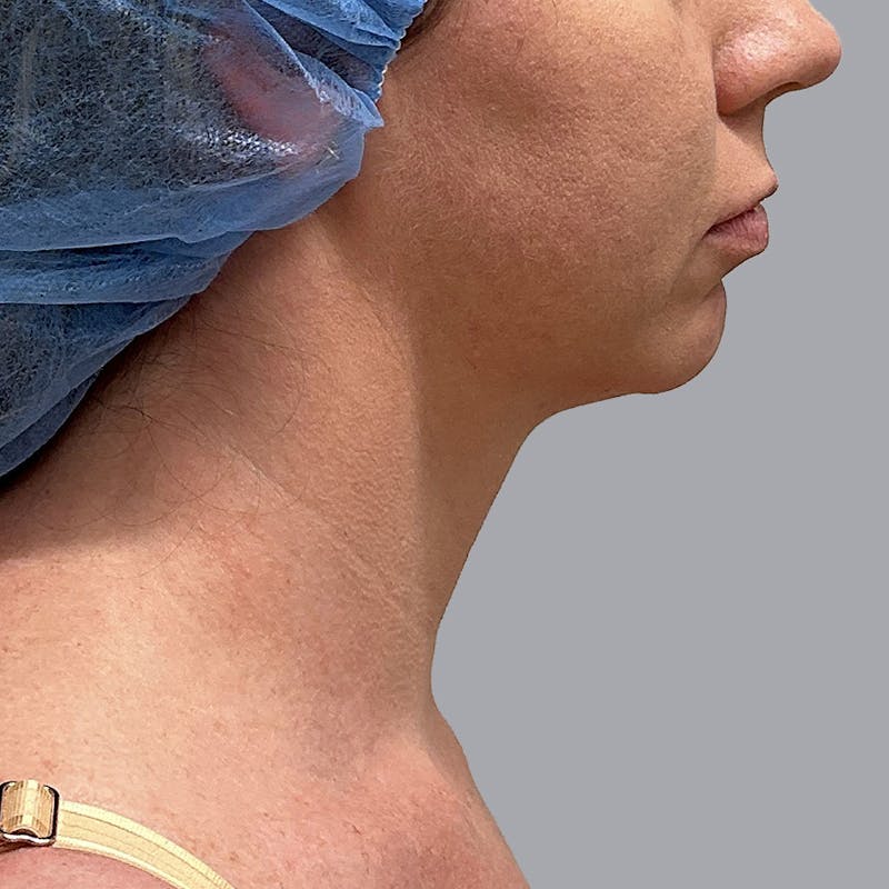 Chin Liposuction Before & After Gallery - Patient 897221 - Image 2