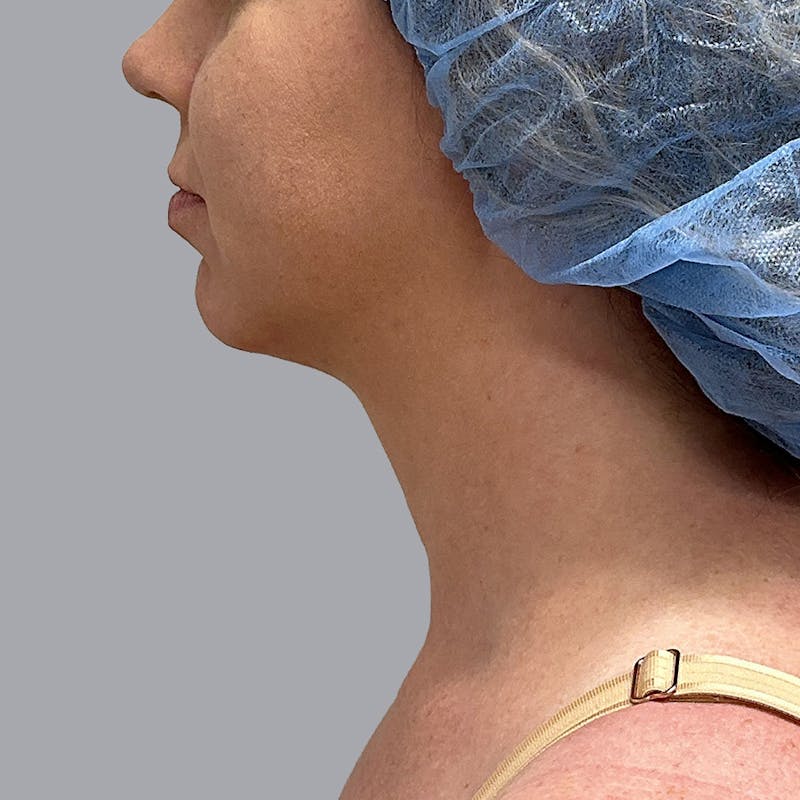 Chin Liposuction Before & After Gallery - Patient 897221 - Image 4